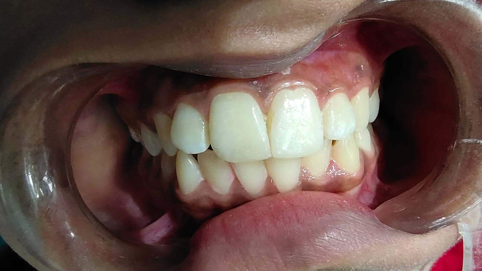 Smile correction after treatment