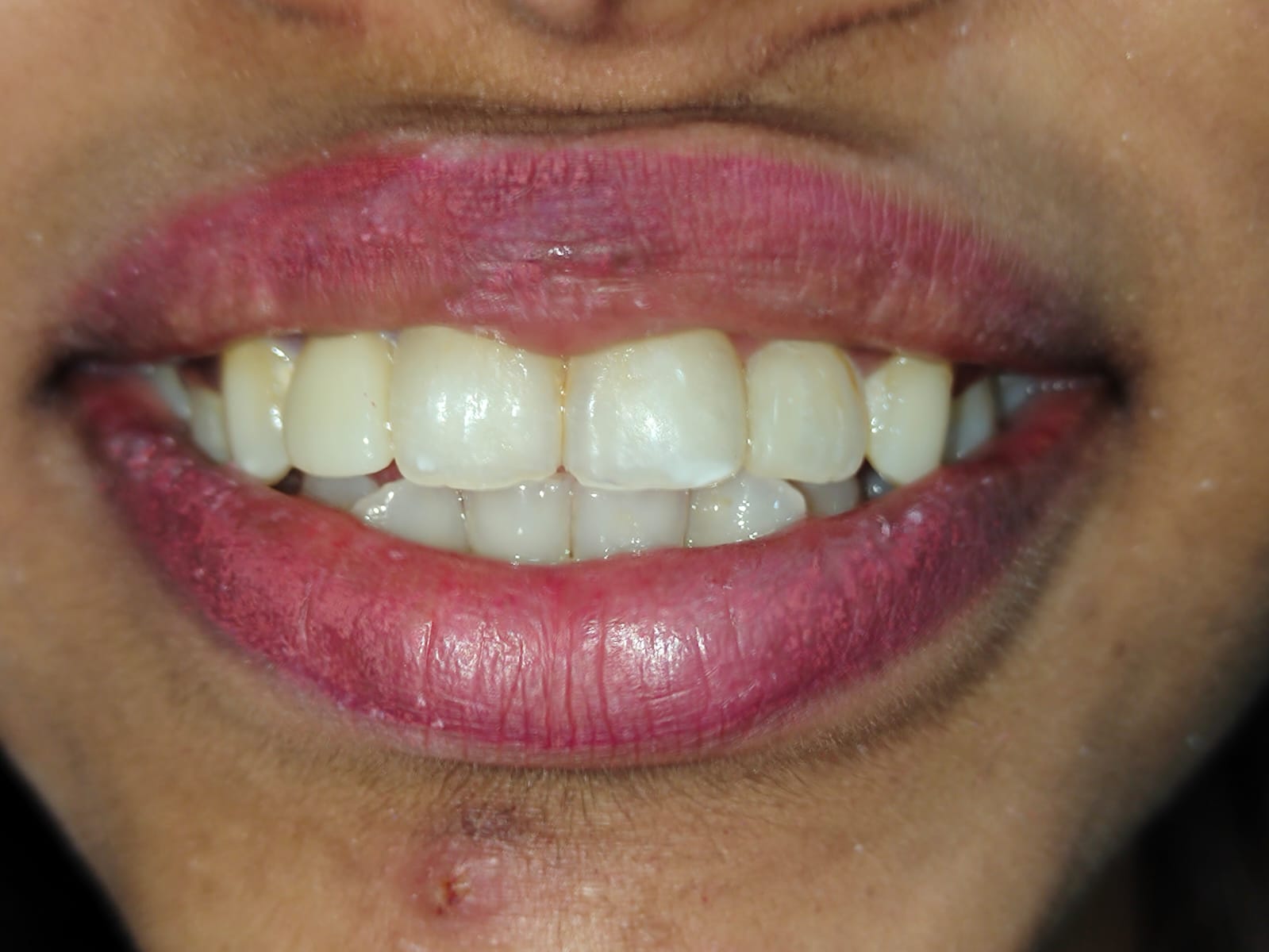 Tooth alignment after treatment