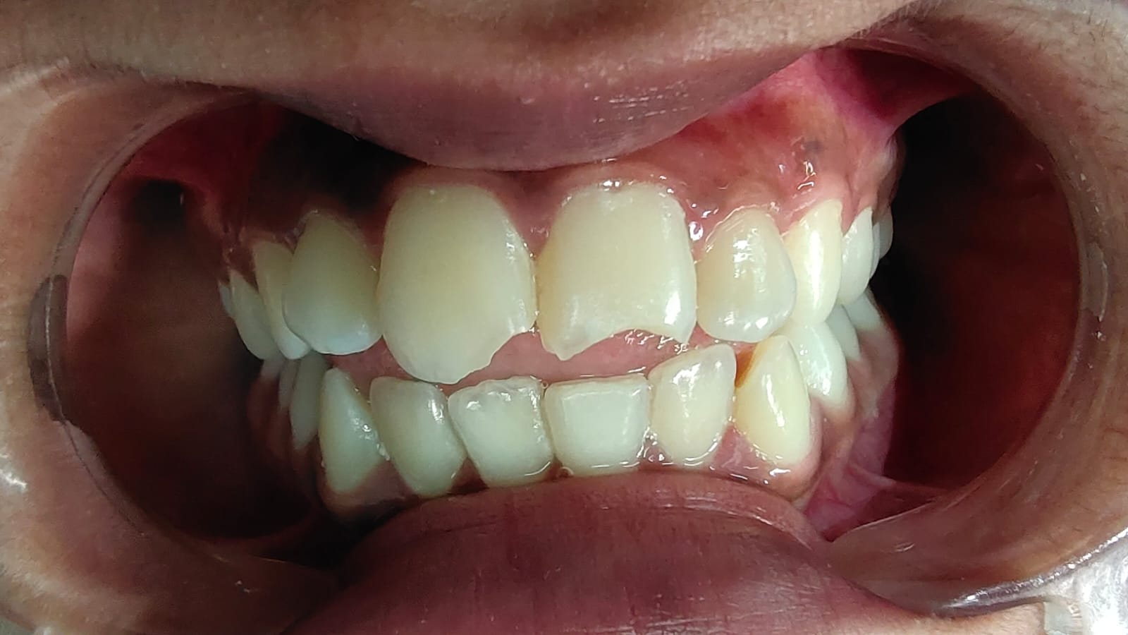 Smile correction before treatment