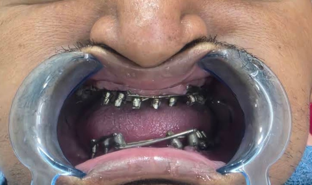 Implant restoration before treatment