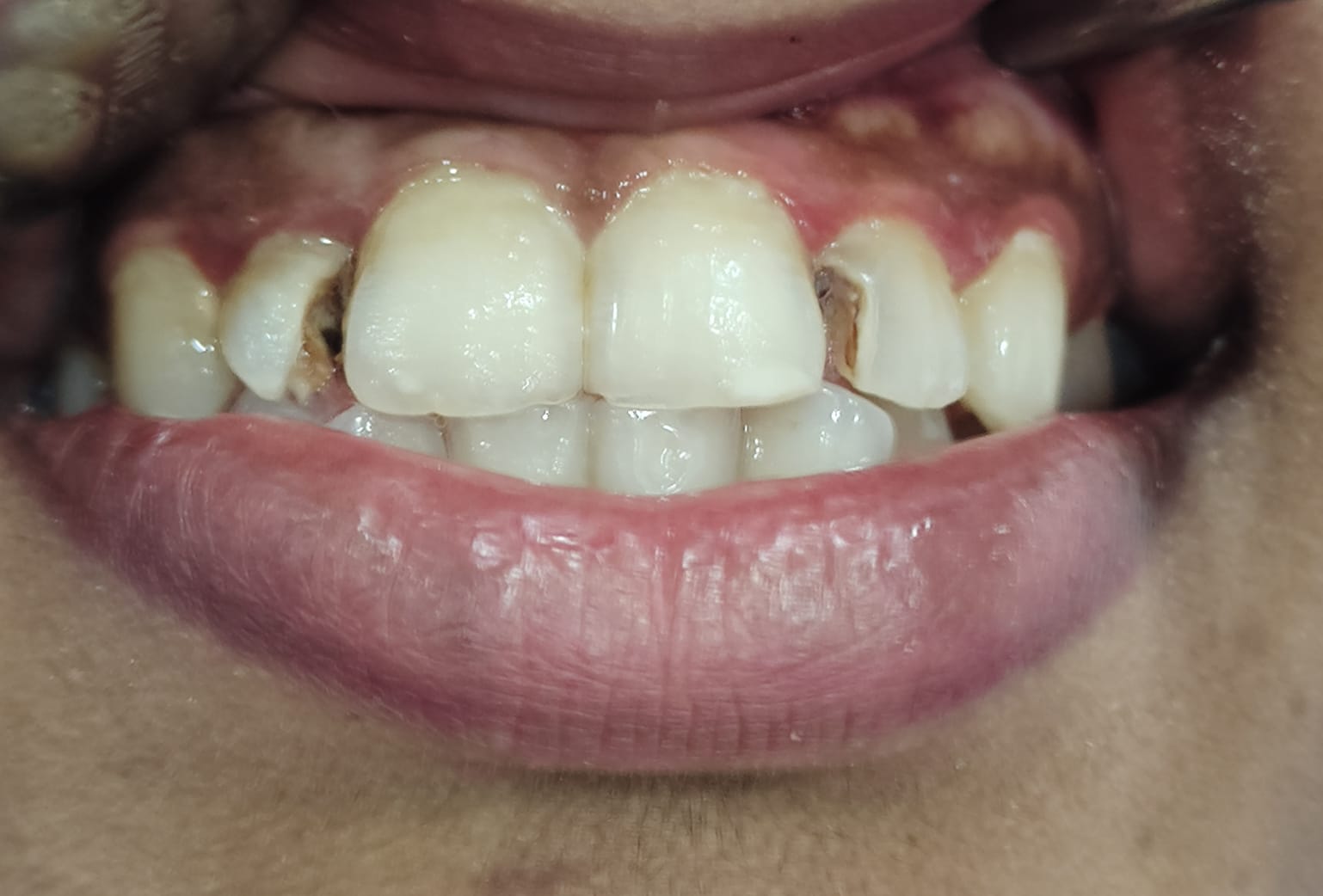 Tooth alignment before treatment