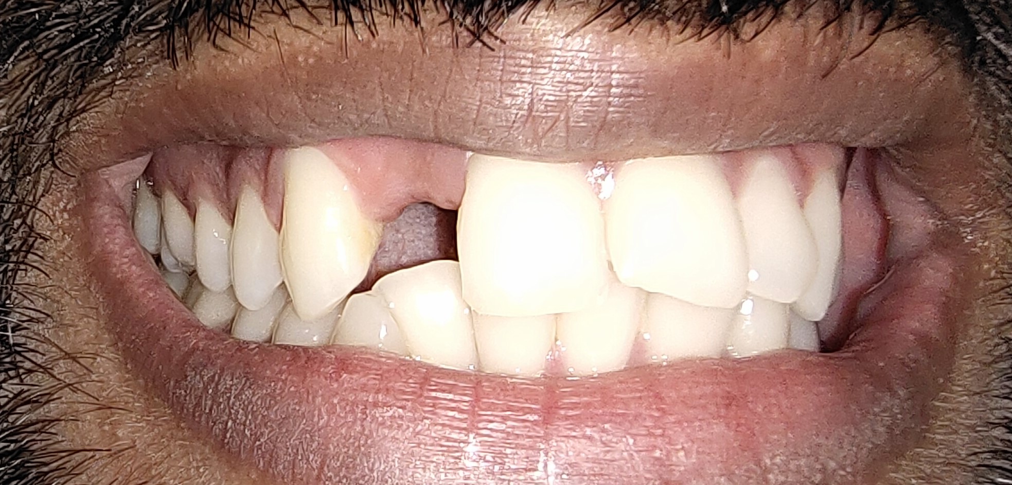 Cosmetic improvement before treatment